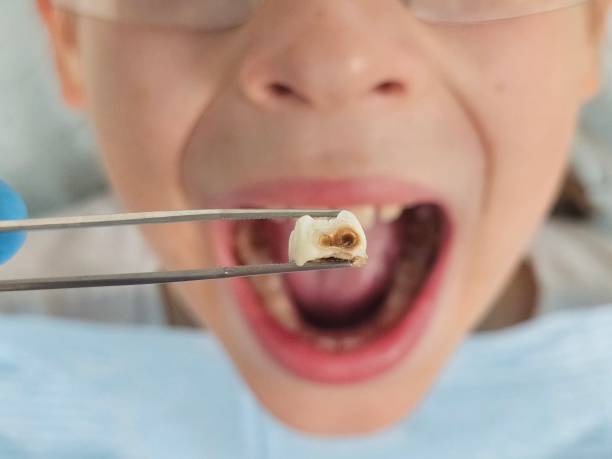 Best Emergency Dental Care for Abscessed Tooth in Wickerham Manor Fisher, PA
